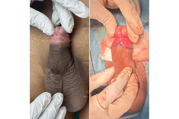 nên chỉnh ngắn dây hãm khi cắt bao quy đầu